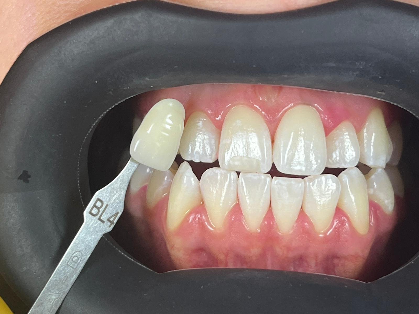 Experience from a dental practice