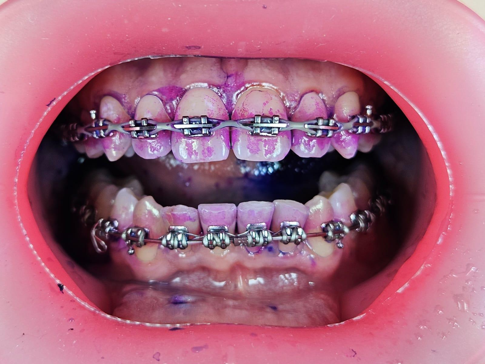 Orthodontic photography with a retractor