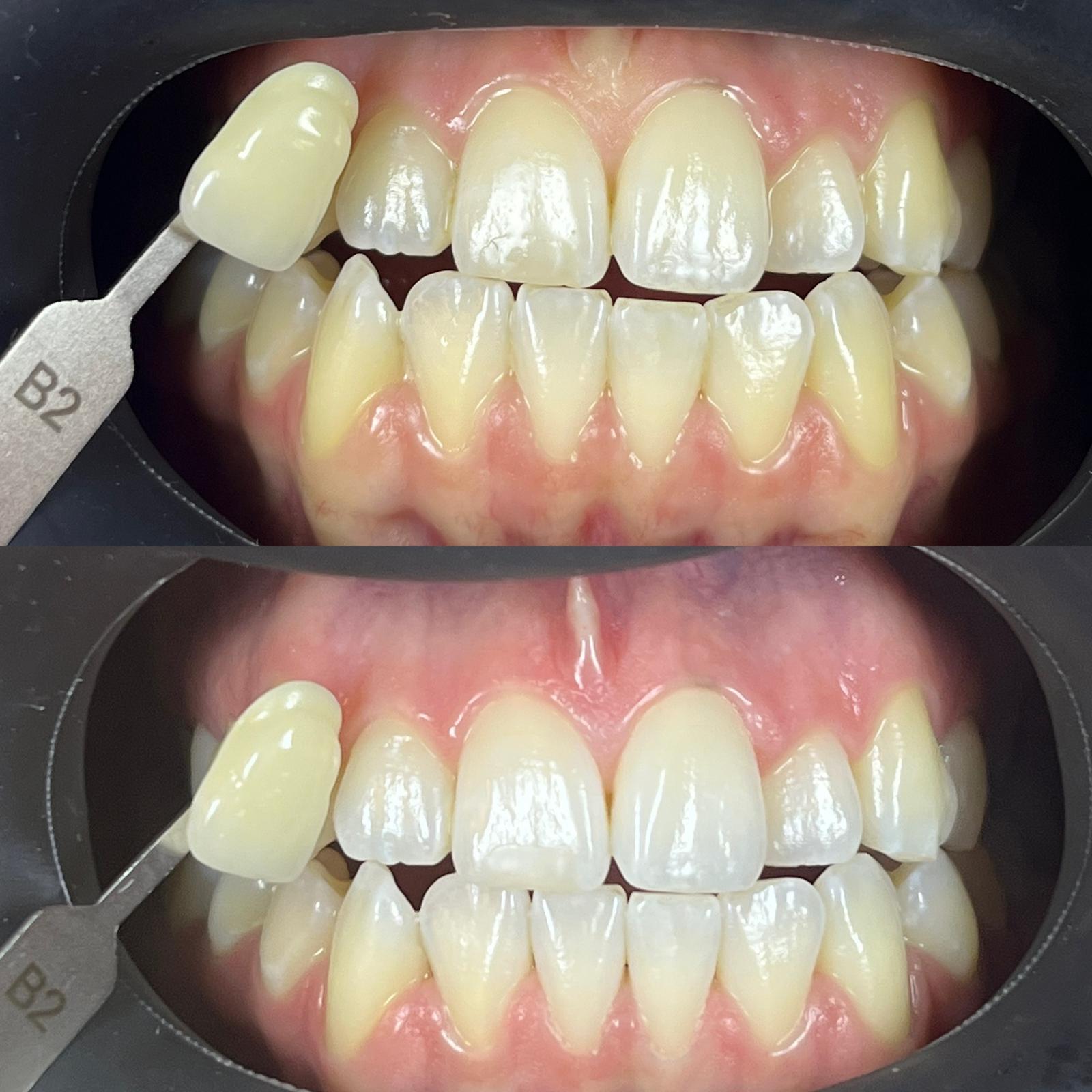 Dental shade selection with a retractor