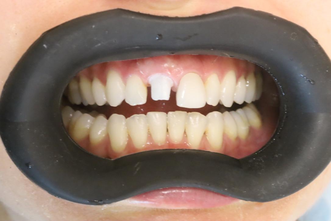 Perfecting Dental Photography with Integrated Contrast Enhancers