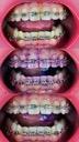 Orthodontics with the VisionButler retractor