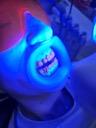 Teeth whitening with the VisionButler retractor